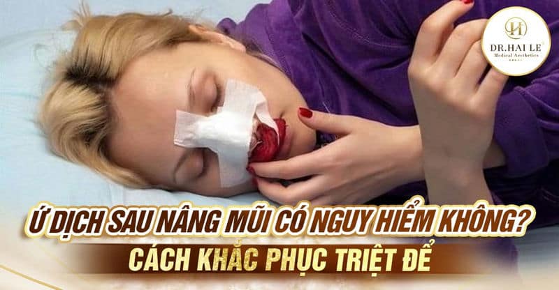 Ứ dịch sau nâng mũi có nguy hiểm không? Cách khắc phục triệt để