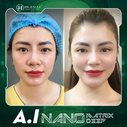 Cắt mí A.I Nano Matrix Deep