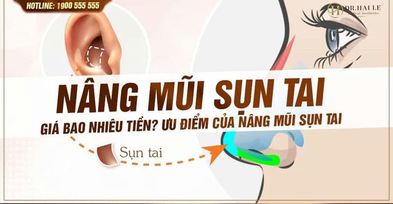 Nâng mũi sụn tai giá bao nhiêu tiền? Ưu điểm của nâng mũi sụn tai