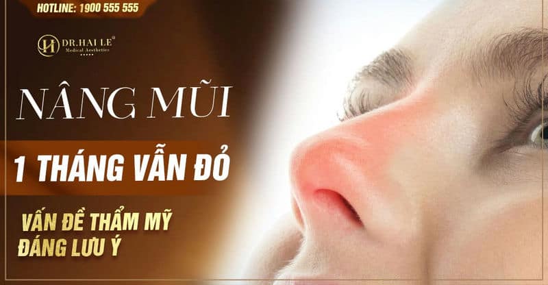 Nâng mũi 1 tháng vẫn đỏ - vấn đề nâng mũi đáng lưu ý?