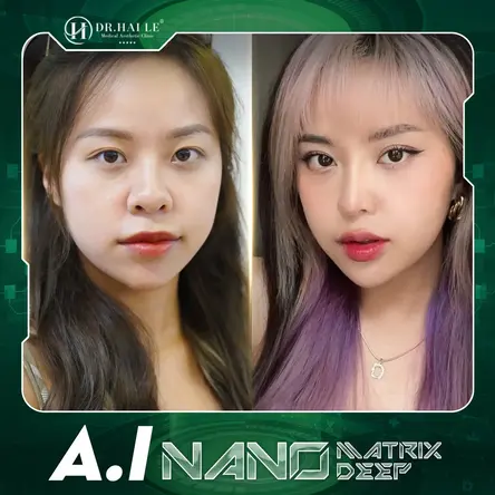 Cắt mí A.I Nano Matrix Deep