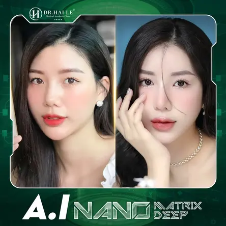 Cắt mí A.I Nano Matrix Deep