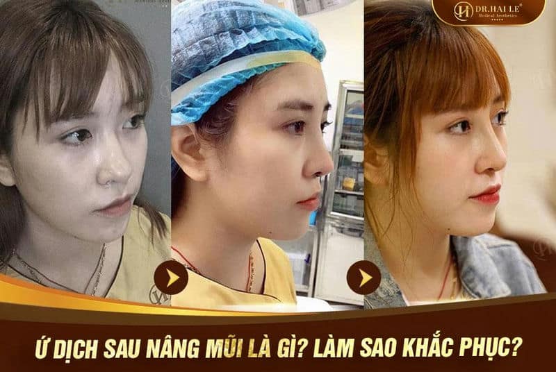 Ứ dịch sau nâng mũi là gì? Làm sao khắc phục?