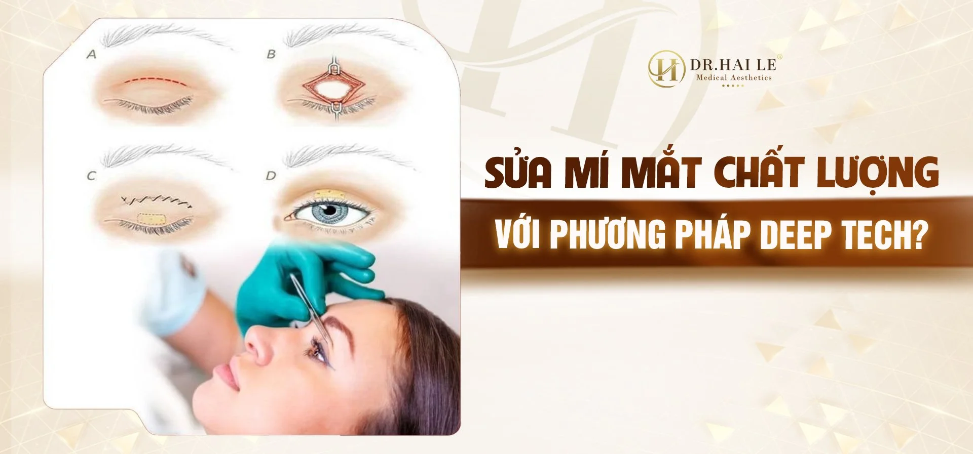 Sửa mí mắt chất lượng với phương pháp Deep Tech? Sửa mí mắt chất lượng với phương pháp Deep Tech?