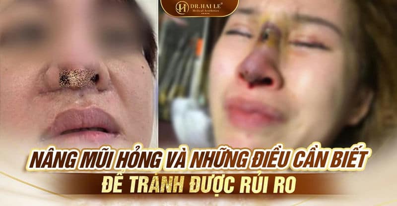 Nâng mũi hỏng và những điều cần biết để tránh được rủi ro