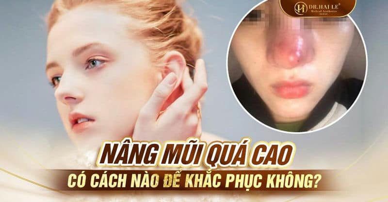 Nâng mũi quá cao có cách nào để khắc phục không?