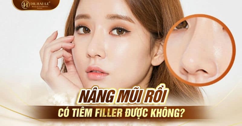 Nâng mũi rồi có tiêm filler được không?