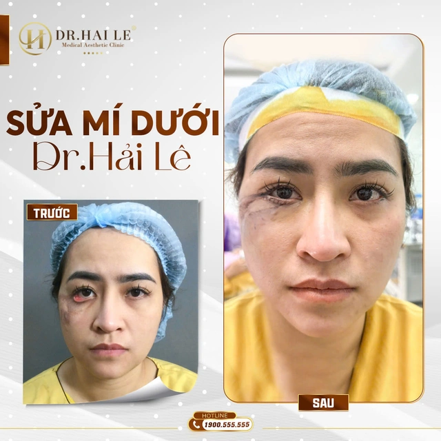 Sua-mi-duoi-bi-lat-tai-drhaile