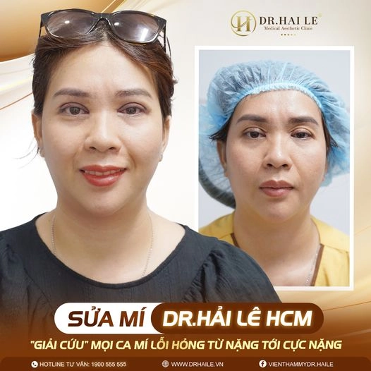 sua-mi-mat-khong-can-nghi-ngoi