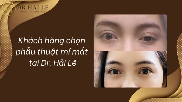sup-mi-mat-don-gian-tai-nha