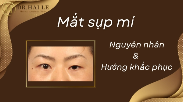 Mắt 2 mí bị sụp: Nguyên nhân, triệu chứng và cách khắc phục từ chuyên gia?