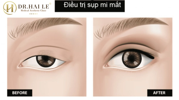 mat-2-mi-bi-sup-3