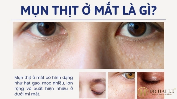 mun-thit-moc-o-mi-mat