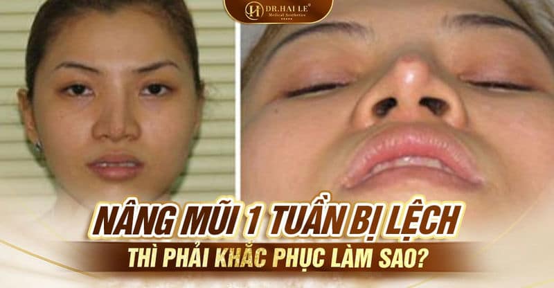 Nâng mũi 1 tuần bị lệch thì phải khắc phục làm sao?