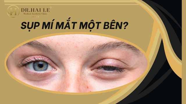 sup-mi-mat-mot-ben