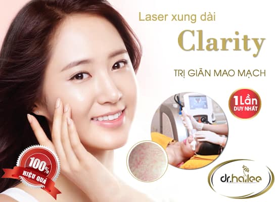 Minh họa điều trị giãn mao mạch bằng laser xung dài Clarity