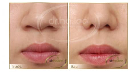 Thu gọn cánh mũi tại Viện thẩm mỹ y khoa Dr.Hải Lê