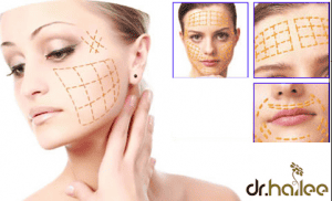 Công nghệ Ultherapy-vị cứu tinh cho phụ nữ tuổi trung niên