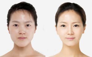Hiệu quả bất ngờ trước và sau khi nâng mũi