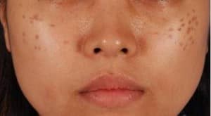 Dr.Hải Lê giúp chị em tự tin hơn với khuôn mặt không còn nám đốm