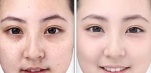 Hiệu quả bất ngờ với công nghệ Laser Spectra