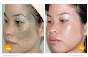 Minh họa xóa chàm bớt bẩm sinh hoàn toàn bằng Laser Spectra