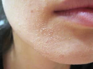 Da mặt khô nhăn nứt nẻ mùa đông