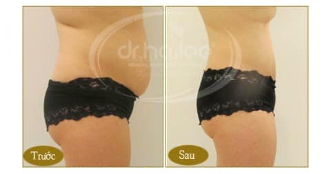 Hình ảnh khách hàng sau khi giảm mỡ bụng bằng công nghệ Cavi-Lipo