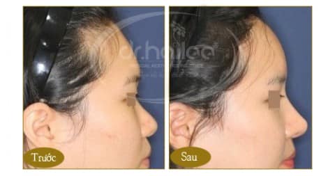 nang-mui-sline