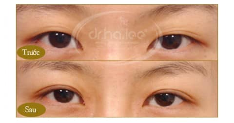 Nhấn mí - dịch vụ làm đẹp  được ưa chuộng hiện nay 2