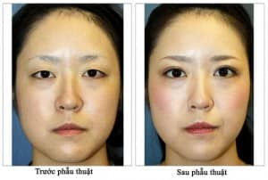 Hiệu quả bất ngờ trước và sau khi thu gọn cánh mũi