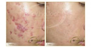 Hiệu quả bất ngờ trước và sau khi điều trị với công nghệ Laser Spectra
