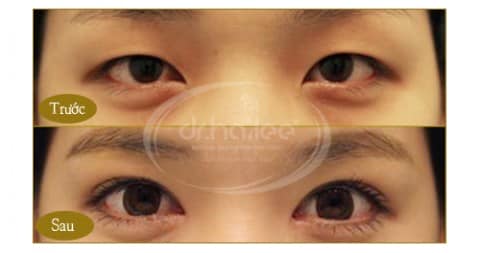 Bấm mí khắc phục tình trạng đôi mắt sụp mí