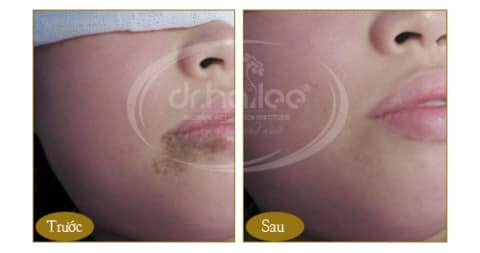 Kết quả xóa chàm, xóa bớt bẩm sinh bằng Laser Spectra