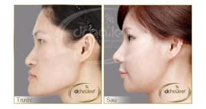 Hiệu quả bất ngờ trước và sau khi nâng mũi S-line