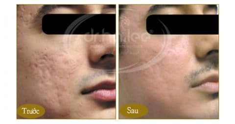 phuong-phap-xoa-seo-lom-hieu-qua