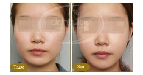 Khuôn mặt trái xoan và khuôn mặt chữ V có gì khác nhau 2