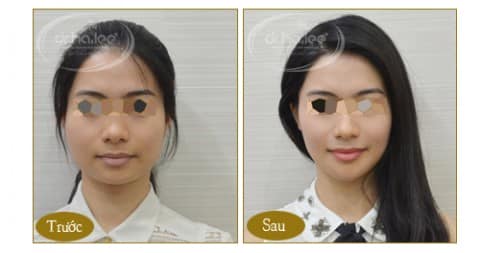 Làm thế nào để tạo khuôn mặt chữ V mà không phải phẫu thuật 2