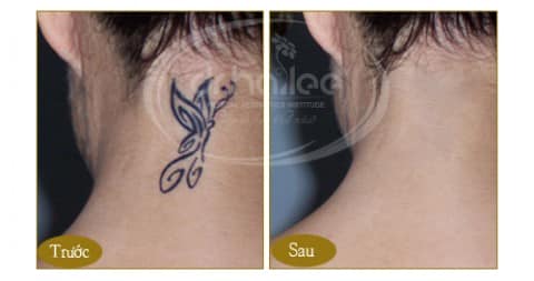 Hình ảnh trước và sau xóa xăm tại Dr.Hải Lê