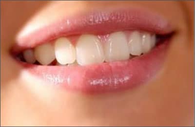 Nha đam điều trị môi khô nứt nẻ