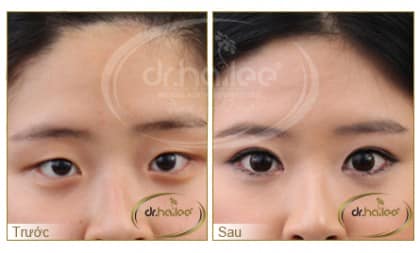 Khách hàng trước và sau khi sử dịch vụ nhấn mí Hàn Quốc