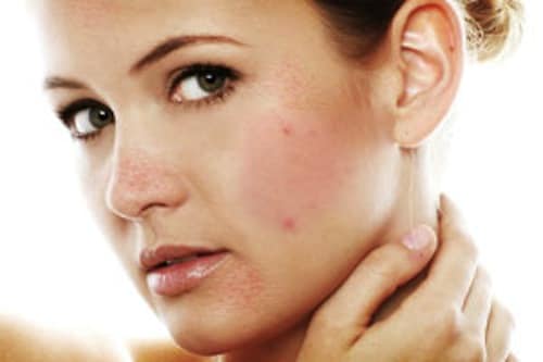 Điều trị da khô và trị mụn