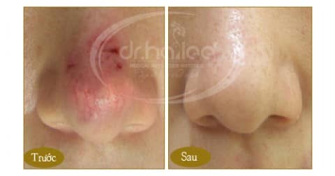 Kết quả trị giãn mao mạch ở mũi