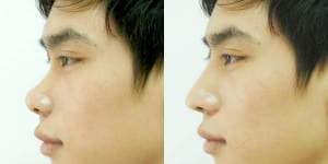 Hình ảnh trước và sau khi nâng mũi cho nam giới